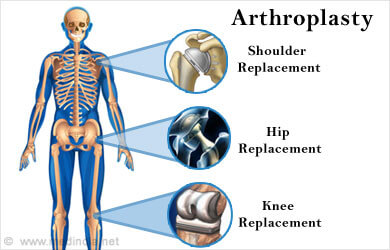 Arthroplasty Nursing Homework Help