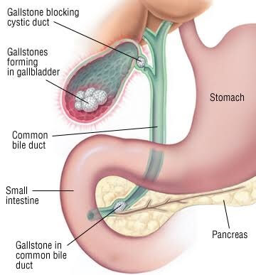 Gallbladder and Biliary disease