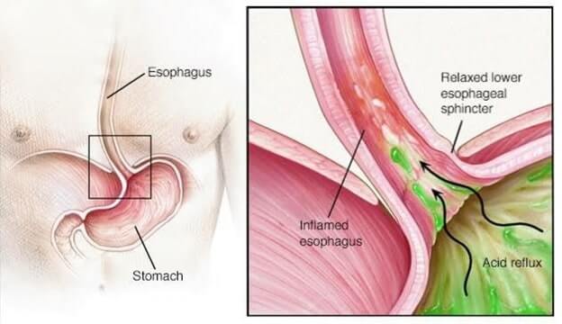 GERD Nursing Image 1