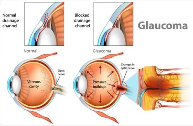 Glaucoma Nursing Assignment