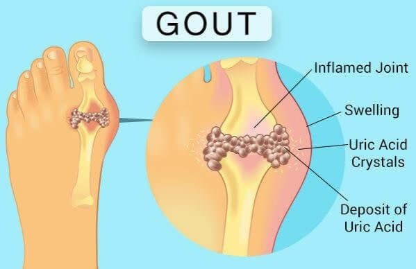 GOUT Nursing