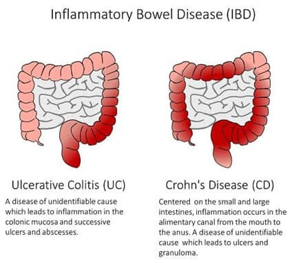 Inflammatory bowel disease Nursing Image 1