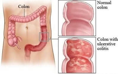 Inflammatory bowel disease Nursing Image 2