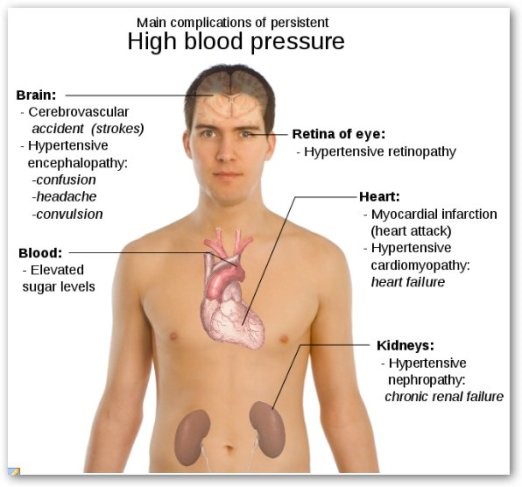 High Blood Pressure